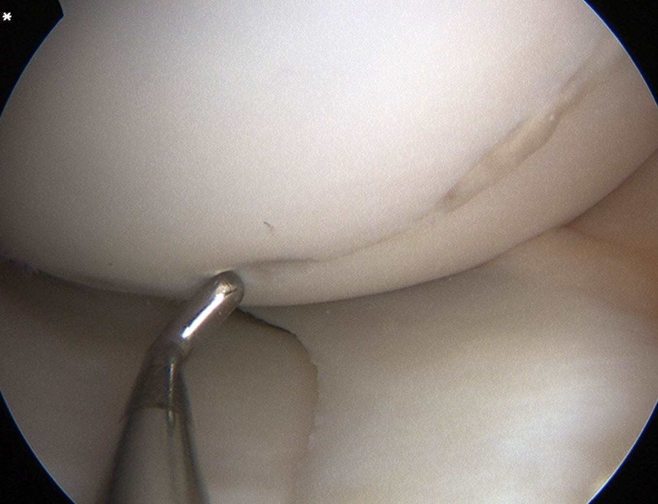 Femoral OCD in situ 